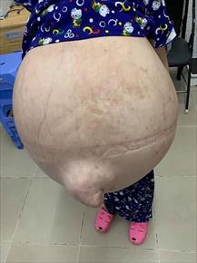 Thiếu nữ 19 tuổi 'bế' khối u khổng lồ, nặng hơn 50 kg
